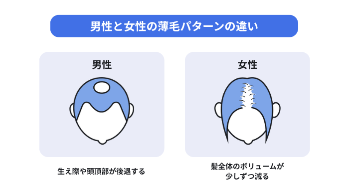 男性と女性の薄毛パターンの違い。男性:生え際や頭頂部が後退する。女性:髪全体のボリュームが少しずつ減る。の画像