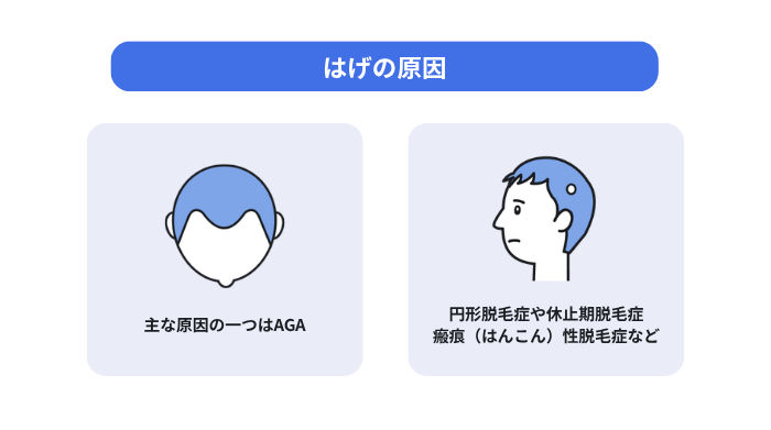 はげの原因として、生え際の後退を示すAGAと、部分的な薄毛を示す円形脱毛症や休止期脱毛症、瘢痕性脱毛症を示した図。