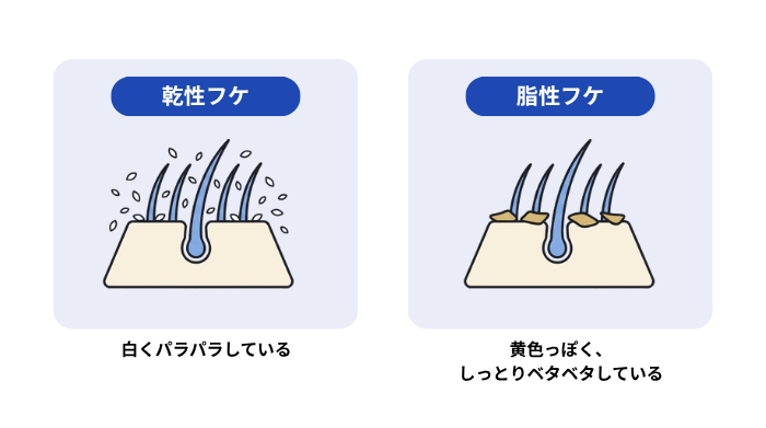 頭皮からパラパラと細かく落ちる乾性フケと、頭皮や髪の根元にベタついて固まる脂性フケの発生状態の違いを比較した図。の画像