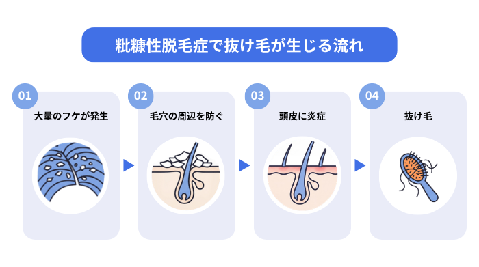 粃糠性脱毛症で抜け毛が生じる流れのイメージ図。01:大量のフケが発生する。02:毛穴の周辺を防ぐ。03:頭皮に炎症が起こる。04:抜け毛が生じる。